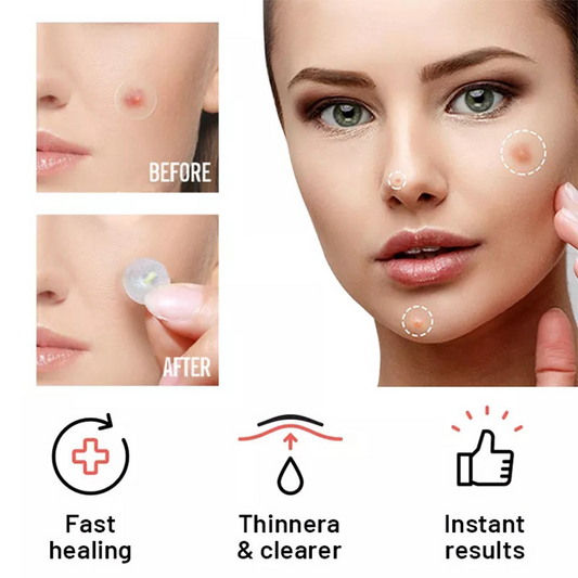 Chin Acne Day And Night Use Repair Acne Patch